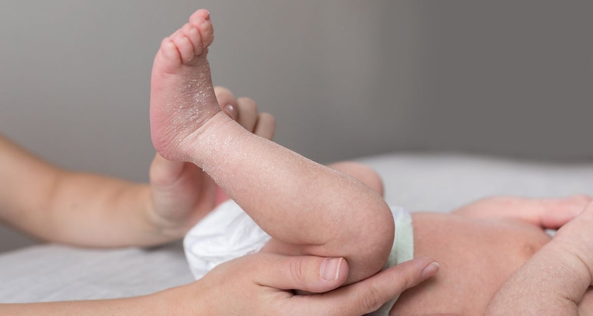Malo bebe so suva koza na nogata