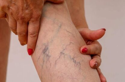 Slika od prosireni veni na noga kaj zena