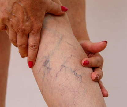 Кои се ризик факторите кои придонесуваат за развој на проширени вени? Slika od prosireni veni na noga kaj zena