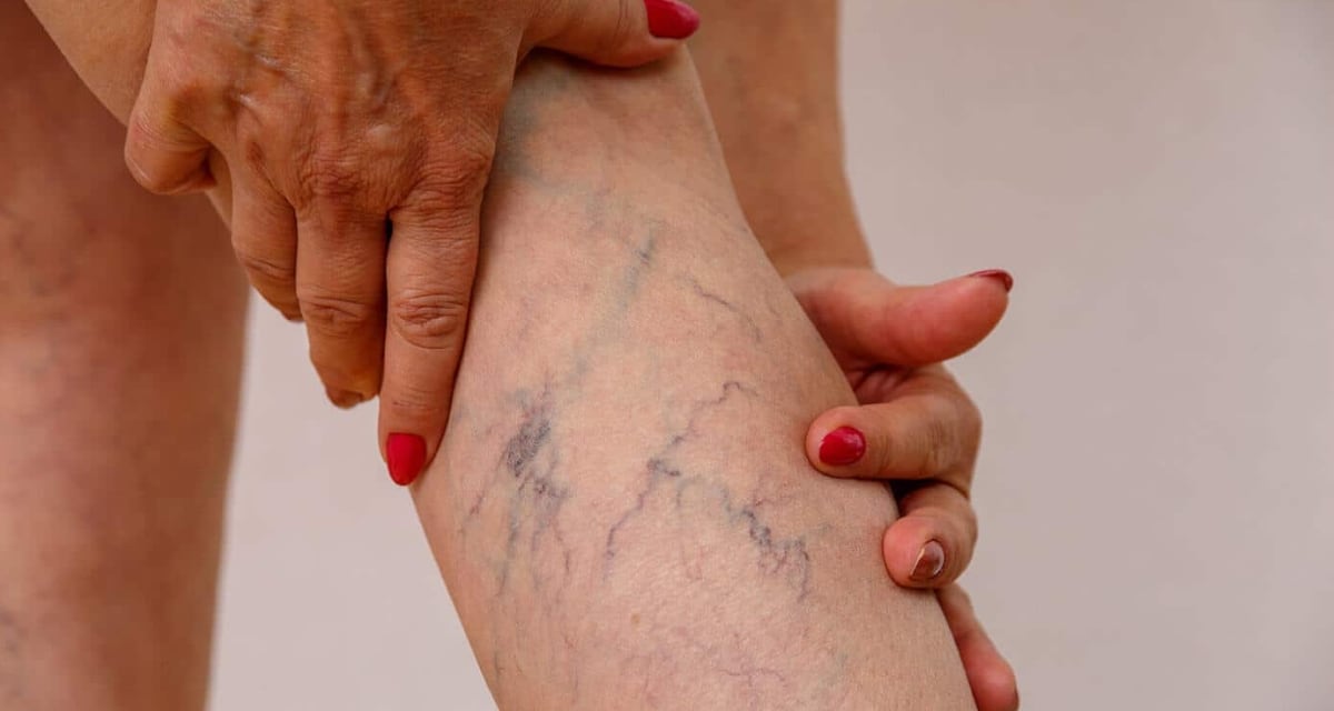 Кои се ризик факторите кои придонесуваат за развој на проширени вени? Slika od prosireni veni na noga kaj zena